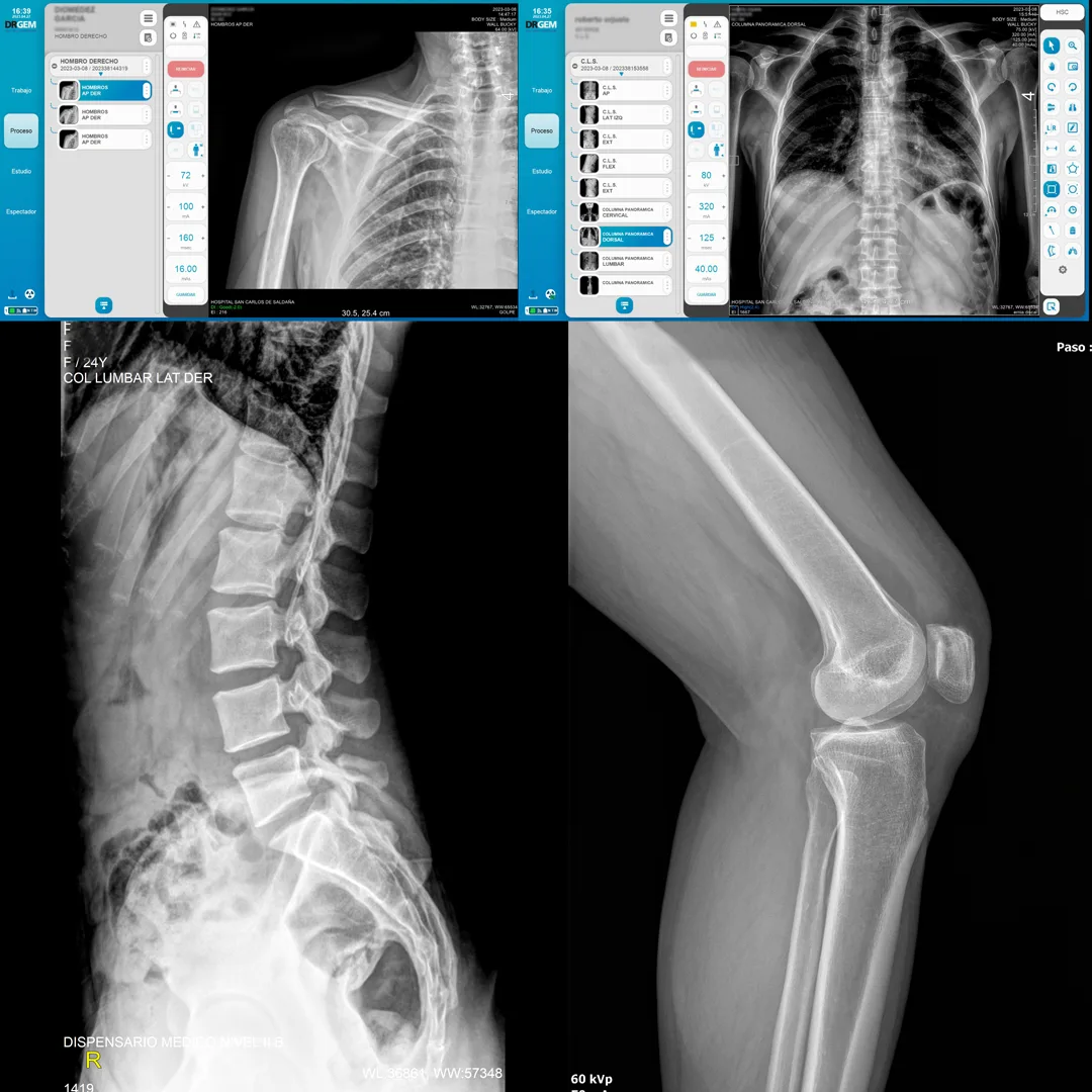 Radiografía lumbar