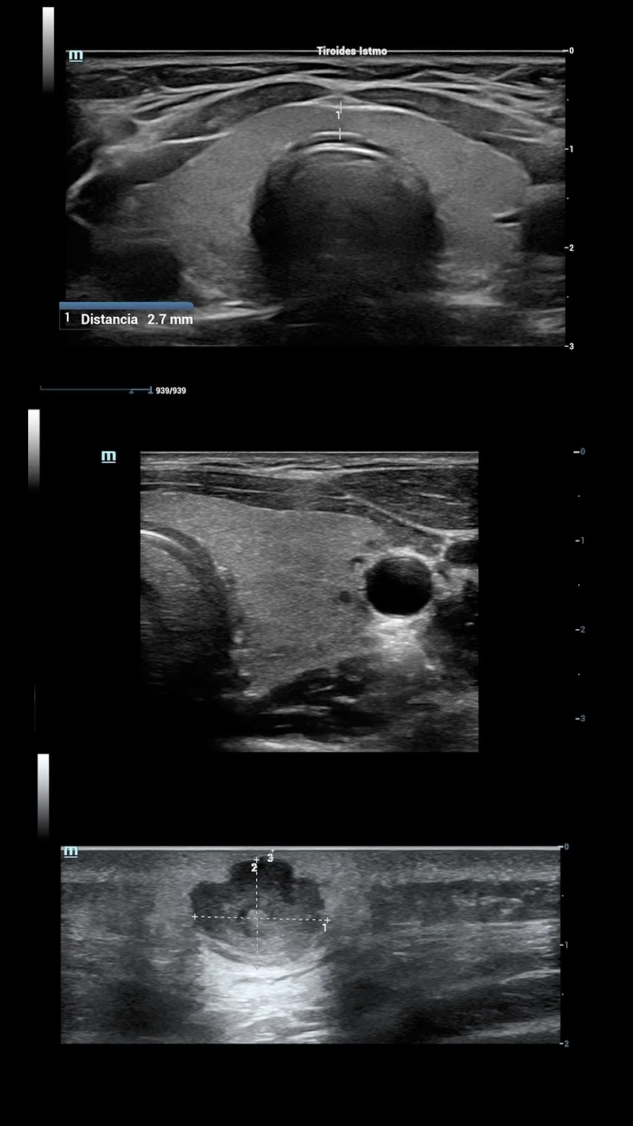 Ultrasonido de tiroides